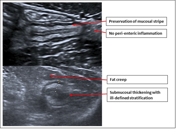 Bowel Ultrasound SoR Bowel Ultrasound SoR