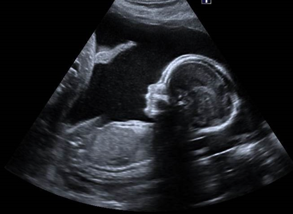 В 20 недель голова. УЗИ 28 недель беременности мальчик. УЗИ 28 недель беременности девочка. УЗИ 27 недель беременности мальчик. УЗИ 18 недель беременности мальчик.
