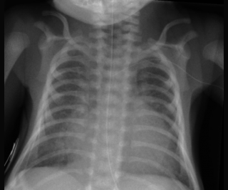 New content to support neonatal chest radiography | SoR