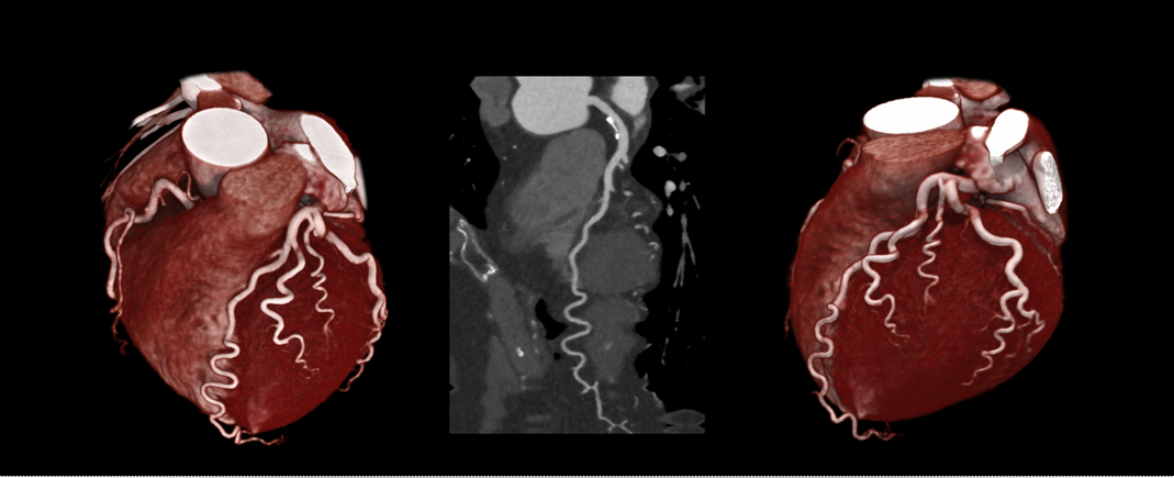 Cardiology / Coronary LAD plaque via Advanced intelligent Clear-IQ Engine (AiCE) on the Aquilion ONE / PRISM Edition CT.