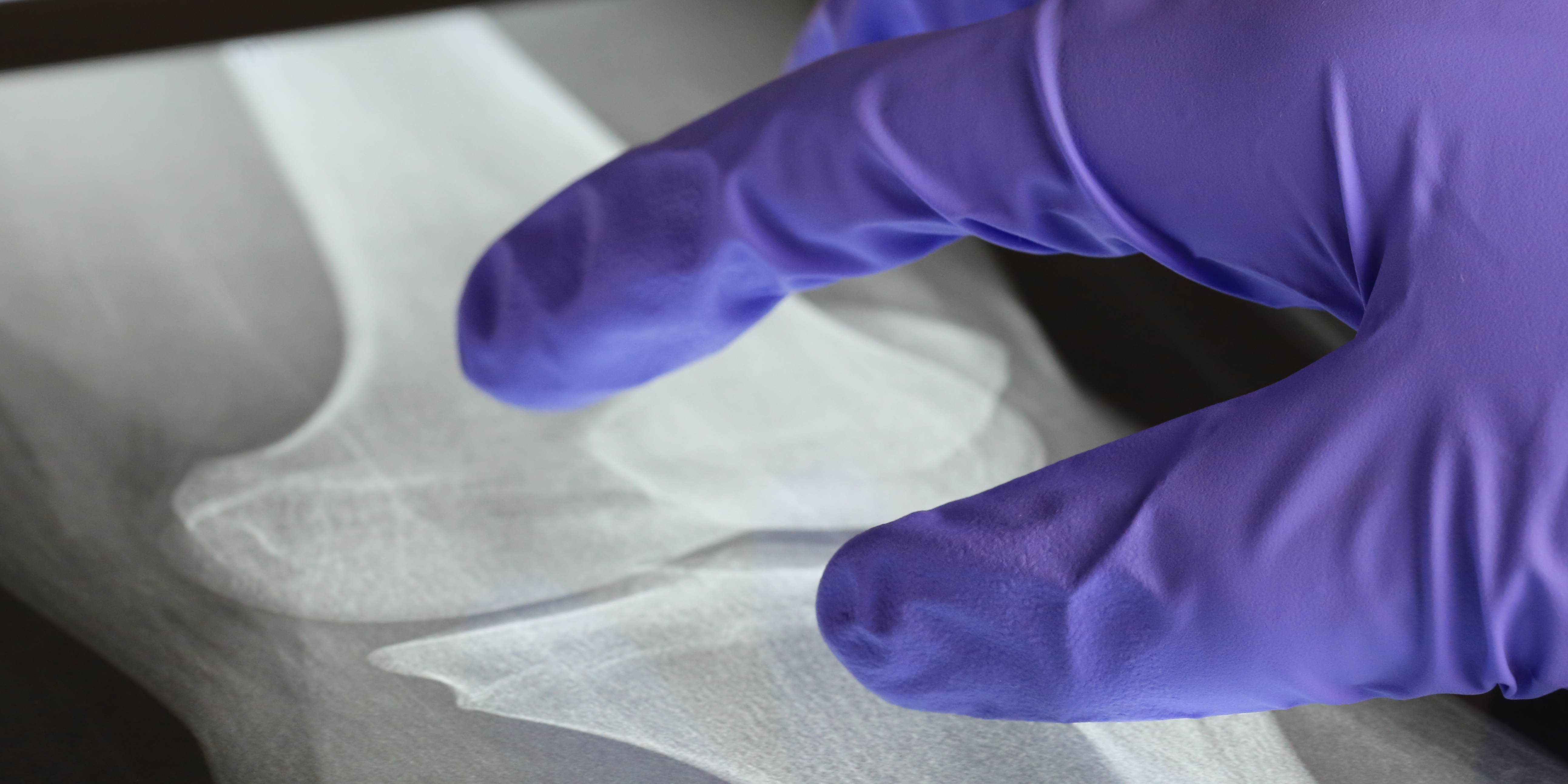 Fractures on Xrays set to be examined by AI but ‘the human factor